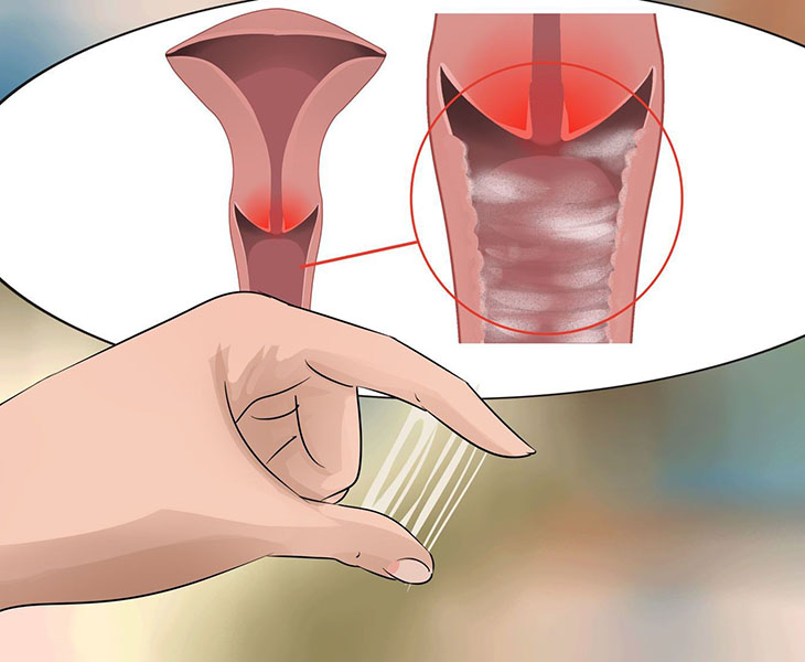 Huyết trắng có sợi máu khi mang thai do viêm âm đạo gây nguy hiểm